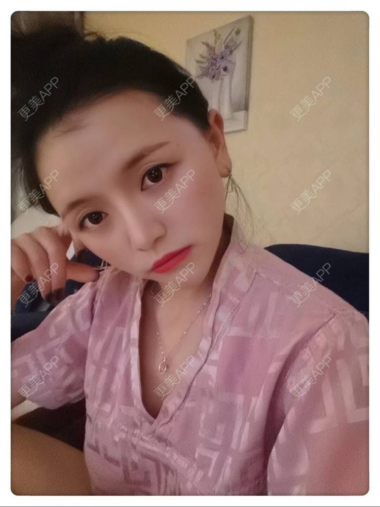 更美 - 二水酱的鼻部多项经验 | 鼻小柱延长 | 硅胶隆鼻 | 鼻孔矫正 | 自体软骨垫鼻尖 | 鼻部多项