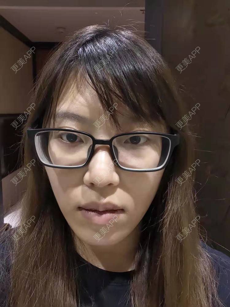 更美 - 更美用户oTj2WxMsId的厚唇改薄经验 | 深圳 | 厚唇改薄