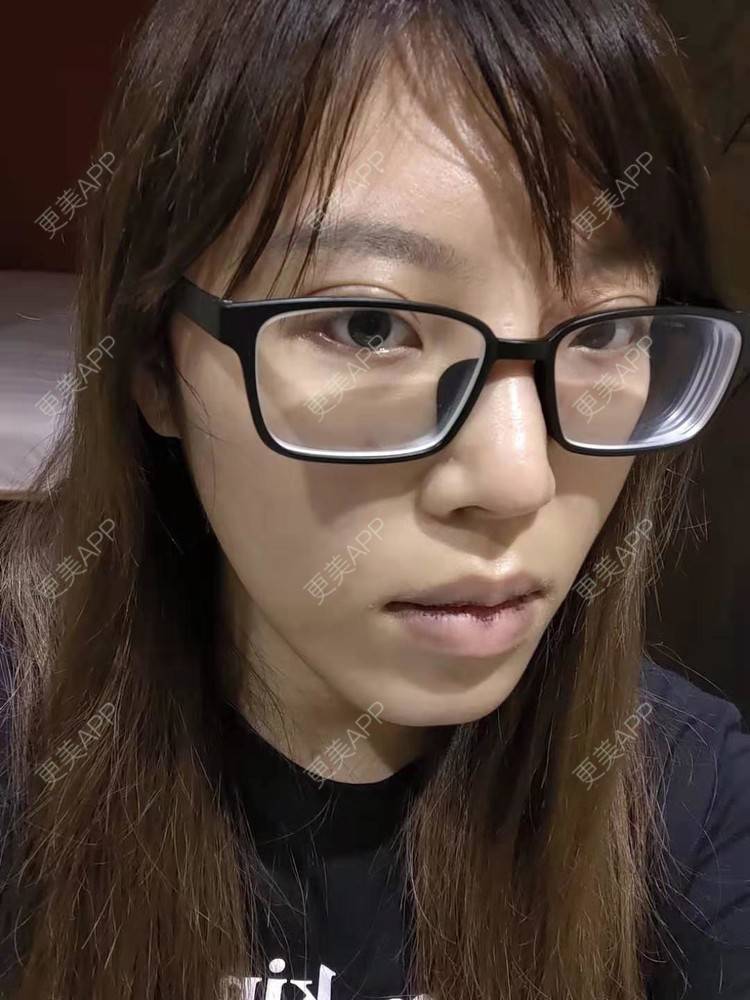 更美 - 更美用户oTj2WxMsId的厚唇改薄经验 | 深圳 | 厚唇改薄