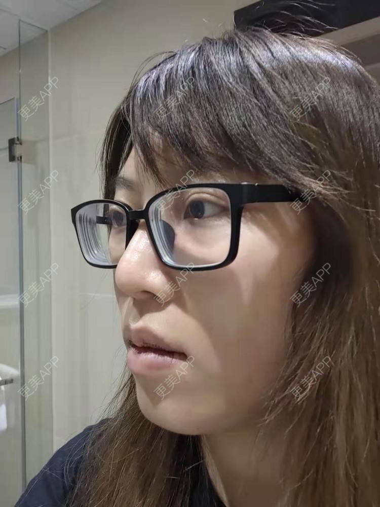 更美 - 更美用户oTj2WxMsId的厚唇改薄经验 | 深圳 | 厚唇改薄