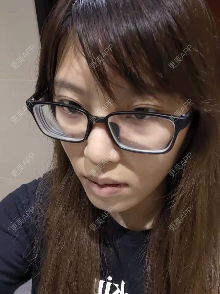 更美 - 更美用户oTj2WxMsId的厚唇改薄经验 | 深圳 | 厚唇改薄