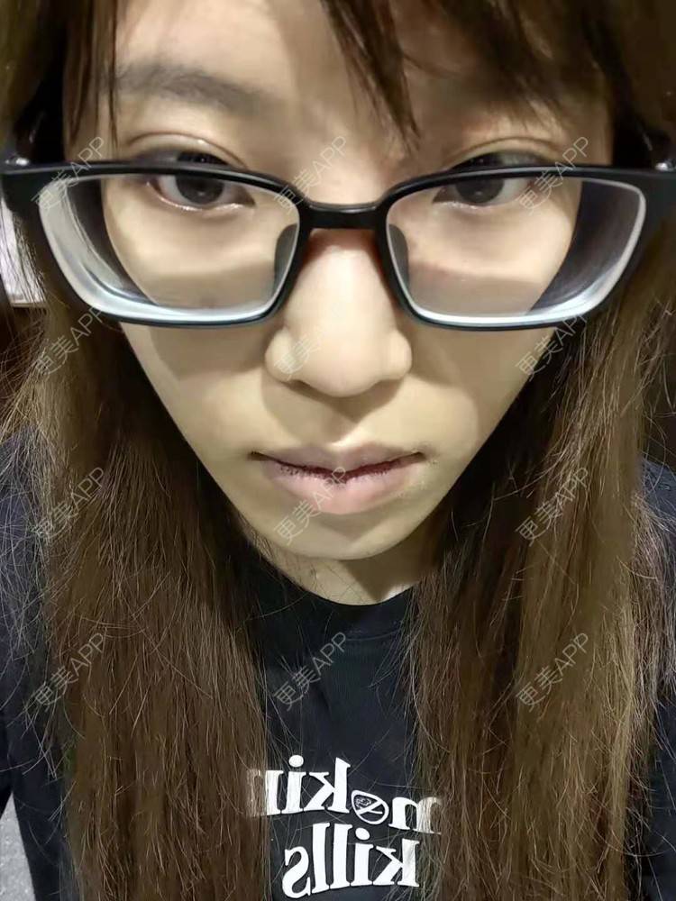 更美 - 更美用户oTj2WxMsId的厚唇改薄经验 | 深圳 | 厚唇改薄