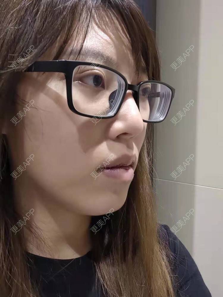 更美 - 更美用户oTj2WxMsId的厚唇改薄经验 | 深圳 | 厚唇改薄