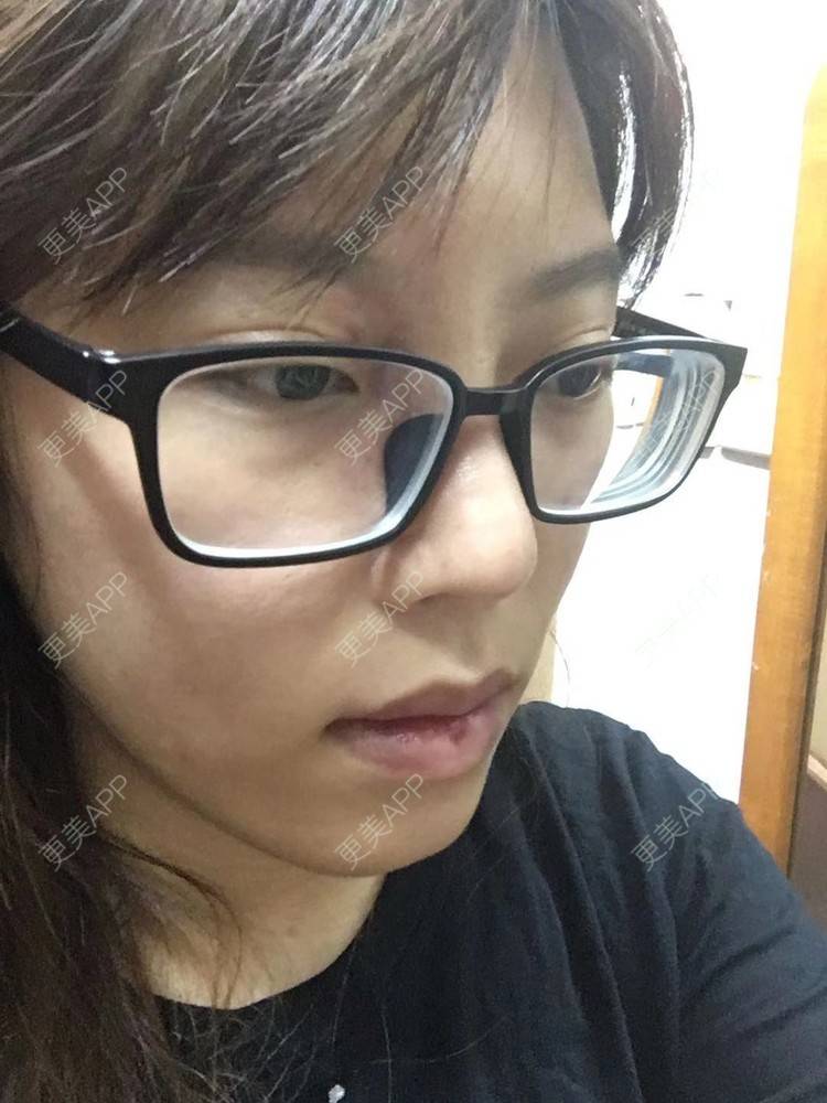 更美 - 更美用户oTj2WxMsId的厚唇改薄经验 | 深圳 | 厚唇改薄