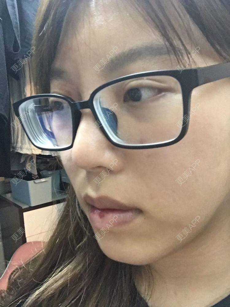 更美 - 更美用户oTj2WxMsId的厚唇改薄经验 | 深圳 | 厚唇改薄