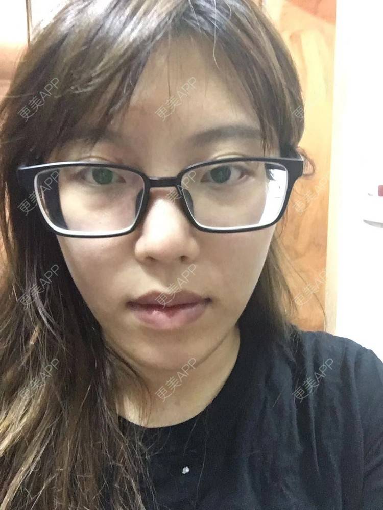 更美 - 更美用户oTj2WxMsId的厚唇改薄经验 | 深圳 | 厚唇改薄