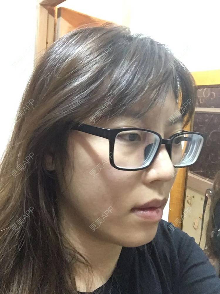 更美 - 更美用户oTj2WxMsId的厚唇改薄经验 | 深圳 | 厚唇改薄