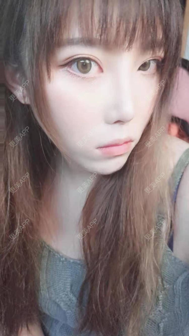 更美 - 更美用户oTj2WxMsId的厚唇改薄经验 | 深圳 | 厚唇改薄