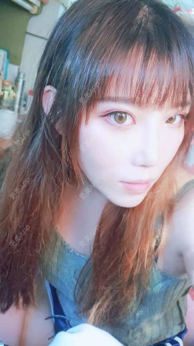 更美 - 更美用户oTj2WxMsId的厚唇改薄经验 | 深圳 | 厚唇改薄