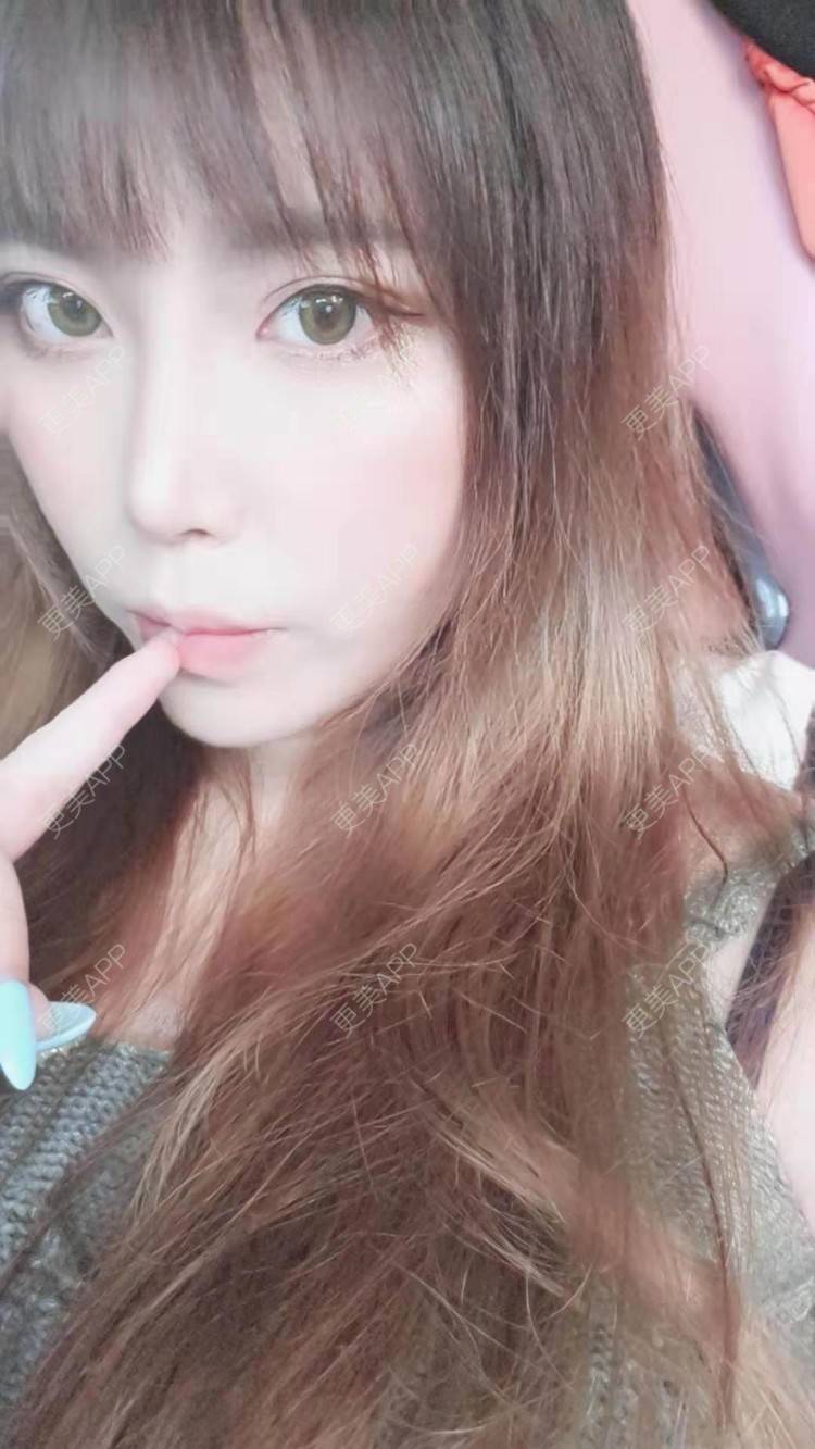 更美 - 更美用户oTj2WxMsId的厚唇改薄经验 | 深圳 | 厚唇改薄