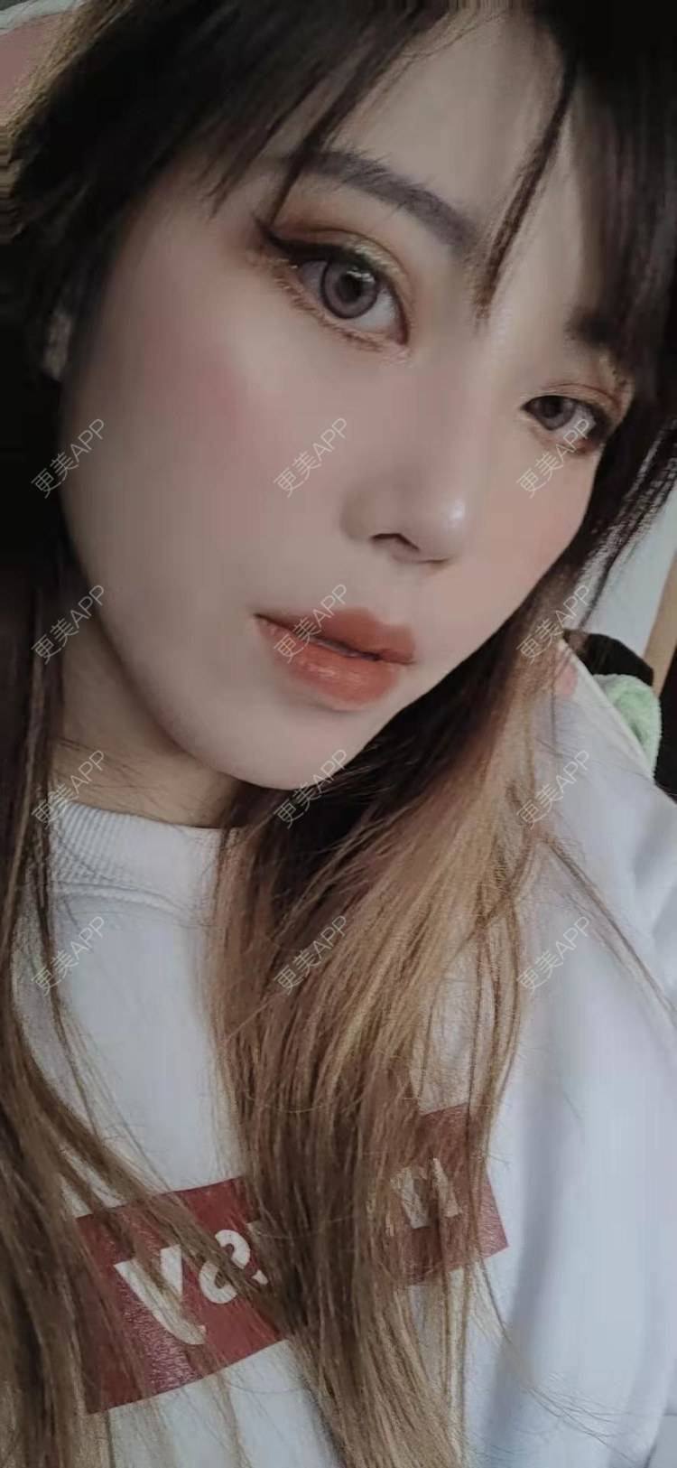 更美 - 更美用户oTj2WxMsId的厚唇改薄经验 | 深圳 | 厚唇改薄