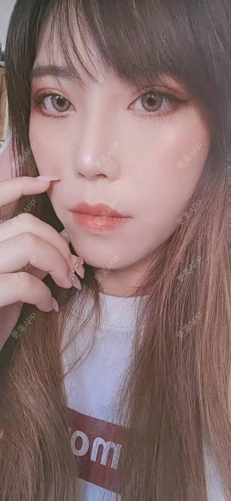 更美 - 更美用户oTj2WxMsId的厚唇改薄经验 | 深圳 | 厚唇改薄