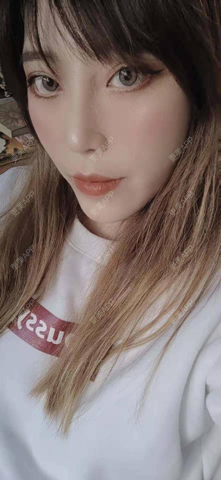 更美 - 更美用户oTj2WxMsId的厚唇改薄经验 | 深圳 | 厚唇改薄