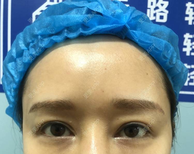 更美 - Jennie🌸小悦儿的开外眼角经验 | 开外眼角 | 提眉修复 | 视频日记 | 上海