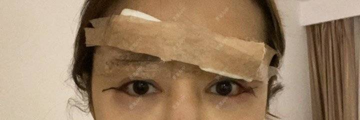 更美 - Jennie🌸小悦儿的开外眼角经验 | 开外眼角 | 提眉修复 | 视频日记 | 上海