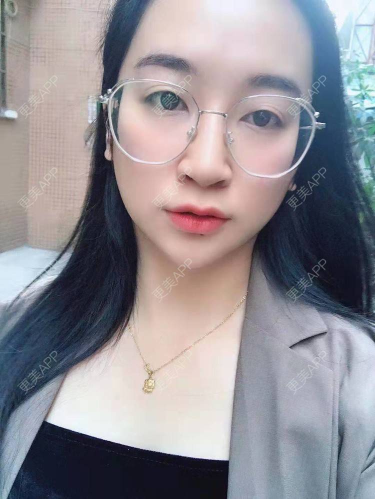 更美 - 更美用户129LF9Yh6a的玻尿酸下巴经验 | 视频日记 | 玻尿酸下巴 | 广州
