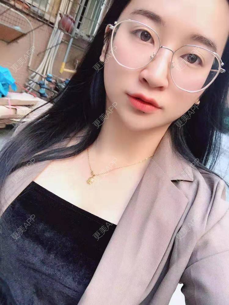 更美 - 更美用户129LF9Yh6a的玻尿酸下巴经验 | 视频日记 | 玻尿酸下巴 | 广州