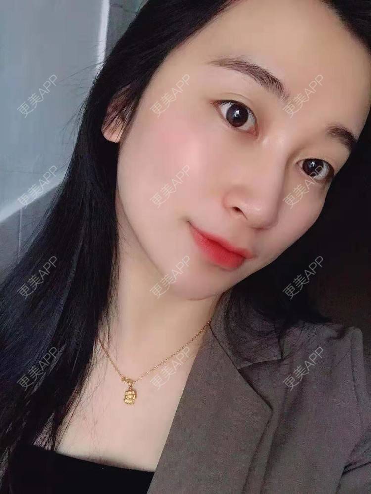 更美 - 更美用户129LF9Yh6a的玻尿酸下巴经验 | 视频日记 | 玻尿酸下巴 | 广州