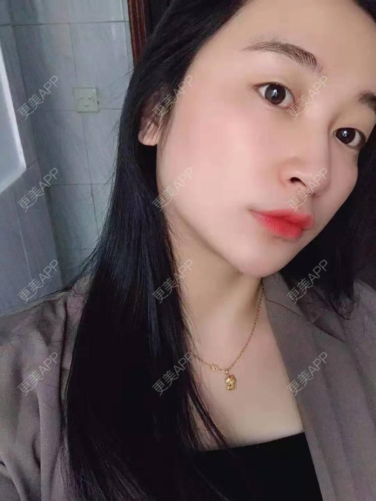 更美 - 更美用户129LF9Yh6a的玻尿酸下巴经验 | 视频日记 | 玻尿酸下巴 | 广州