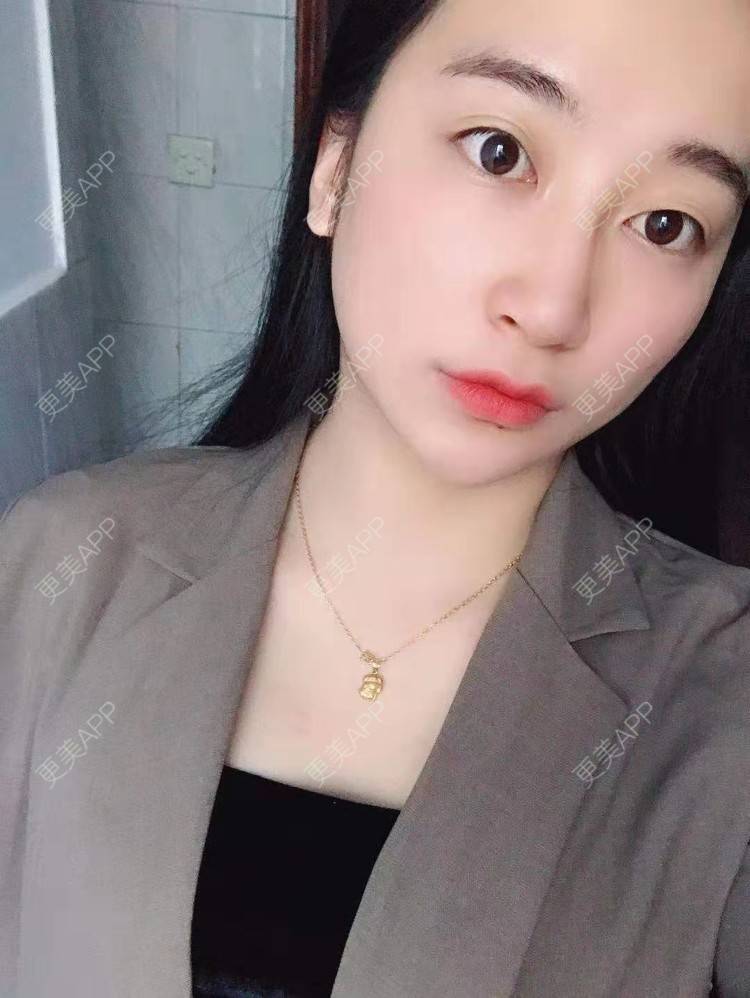 更美 - 更美用户129LF9Yh6a的玻尿酸下巴经验 | 视频日记 | 玻尿酸下巴 | 广州