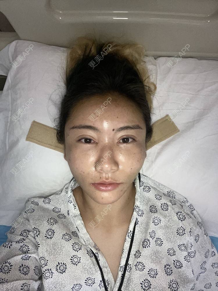 更美 - 哈哈哈镜星的吸脂瘦脸经验 | 自体脂肪全面部填充 | 吸脂瘦脸 | 西安