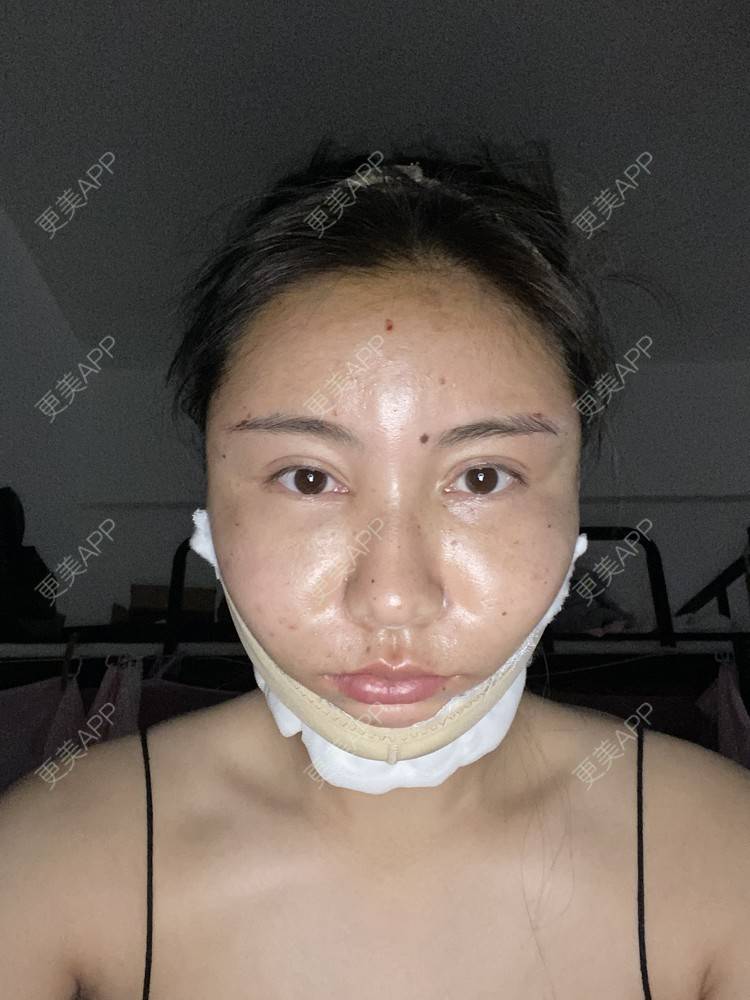 更美 - 哈哈哈镜星的吸脂瘦脸经验 | 自体脂肪全面部填充 | 吸脂瘦脸 | 西安