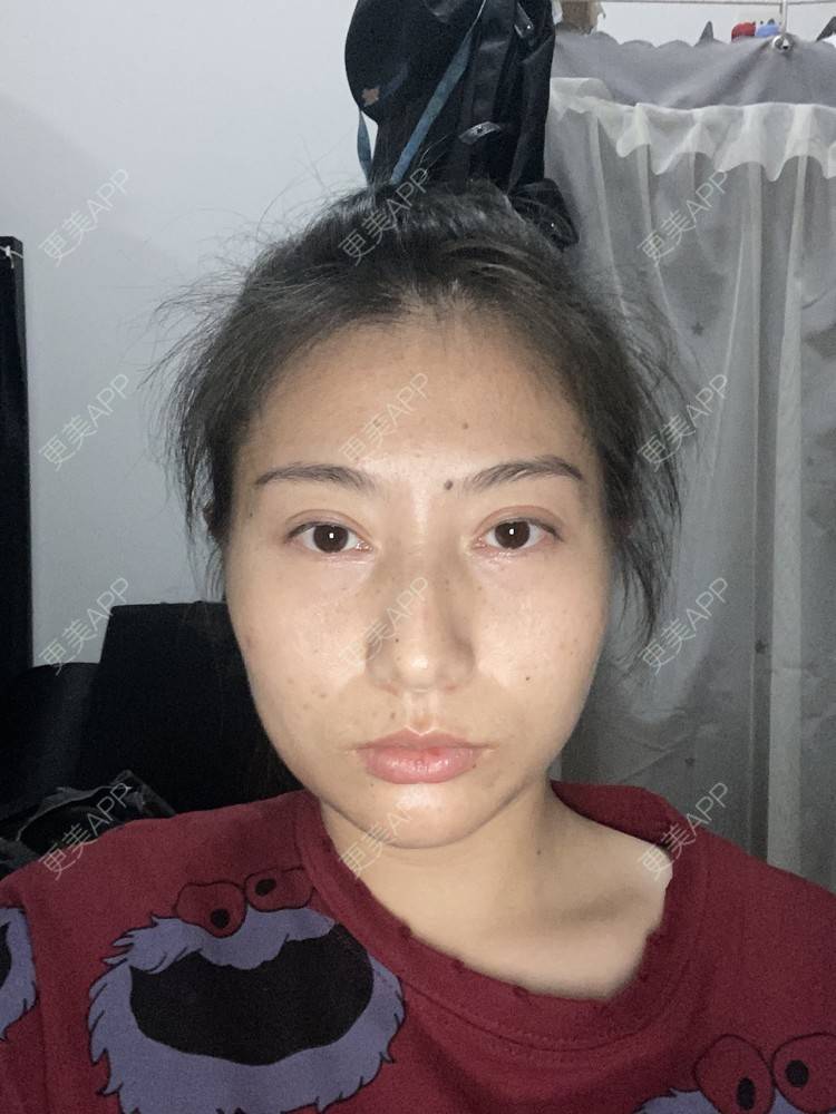 更美 - 哈哈哈镜星的吸脂瘦脸经验 | 吸脂瘦脸 | 西安 | 自体脂肪全面部填充