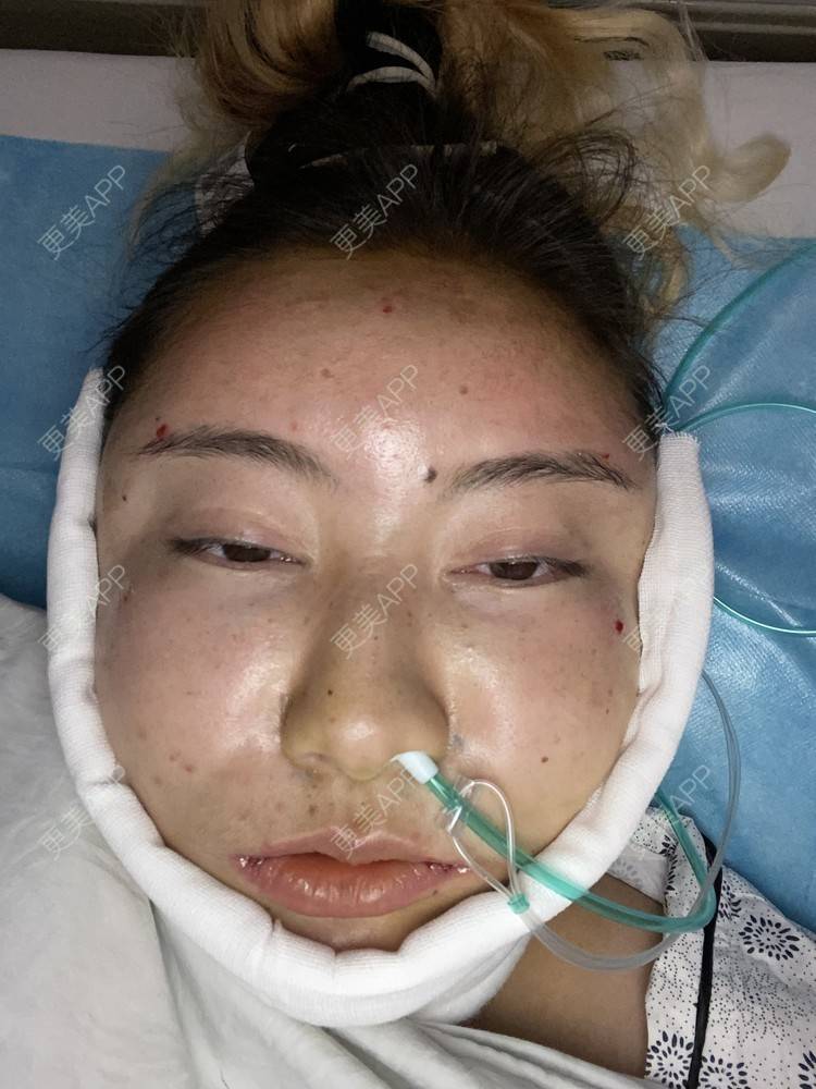 更美 - 哈哈哈镜星的吸脂瘦脸经验 | 自体脂肪全面部填充 | 吸脂瘦脸 | 西安