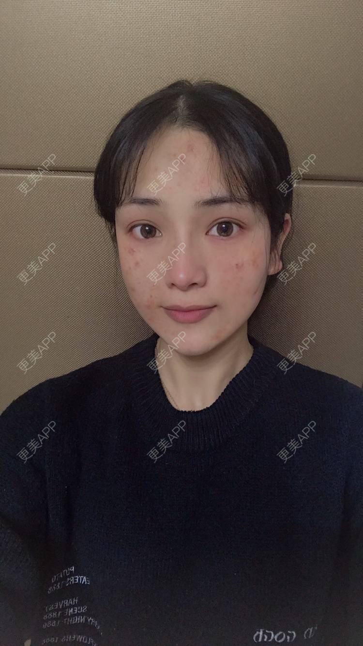 更美用户e210p7jt05的红蓝光清痘日记