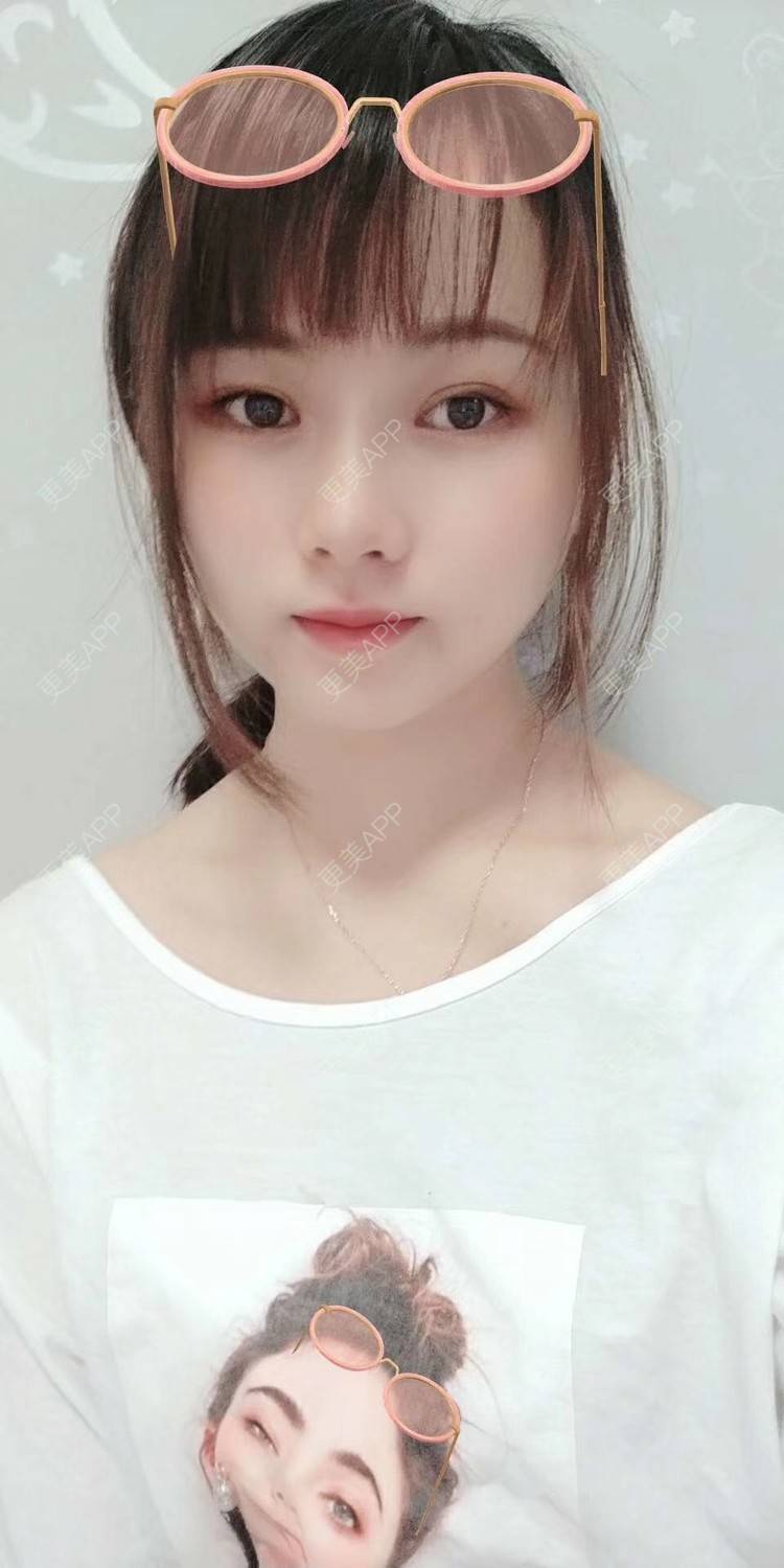 更美 - 米连菊 医生的玻尿酸鼻部经验 | 广州 | 玻尿酸鼻部