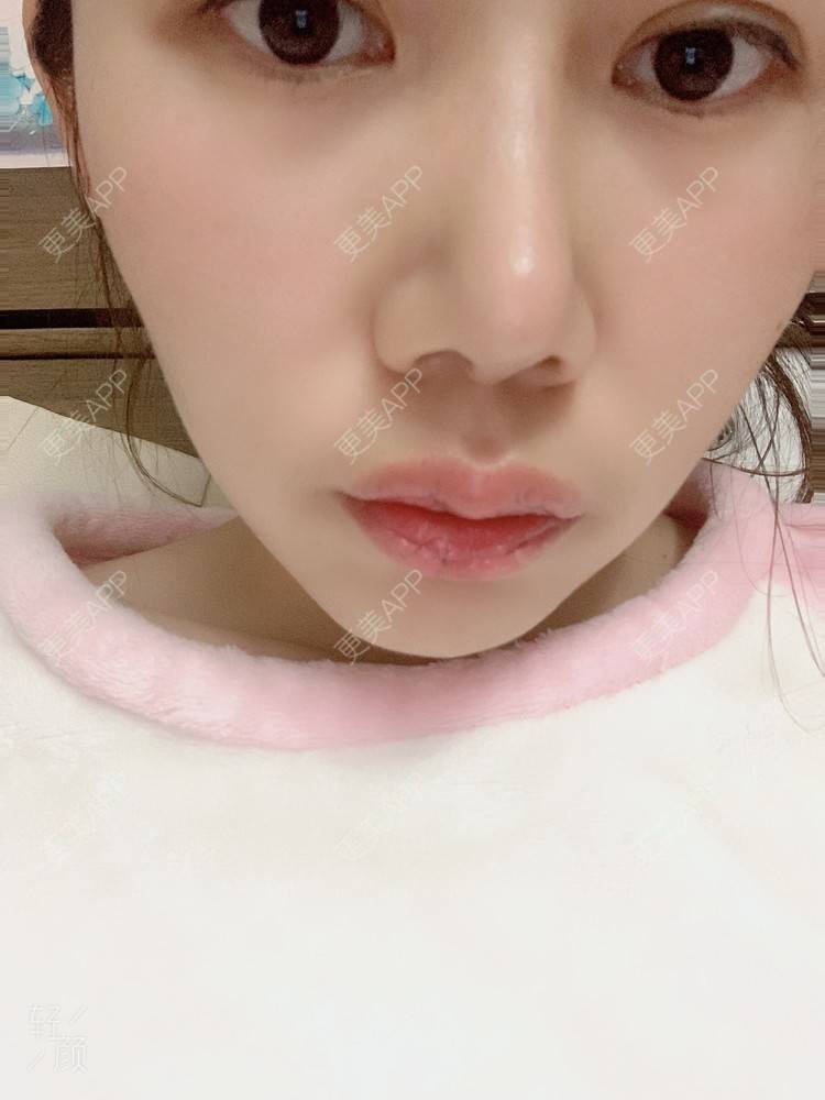 更美 - 浃浃！的厚唇改薄经验 | 厚唇改薄 | 上海