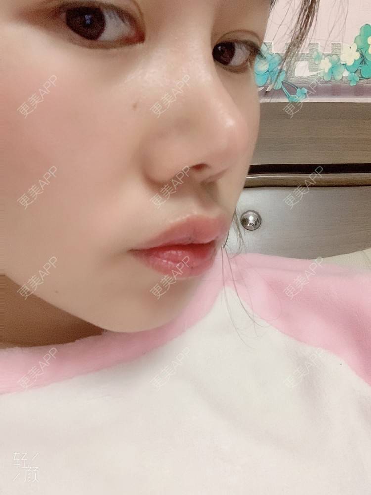 更美 - 浃浃！的厚唇改薄经验 | 厚唇改薄 | 上海