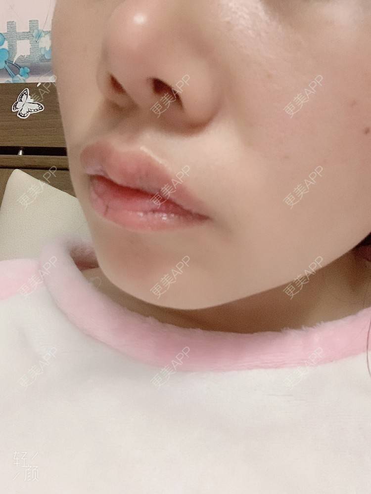 更美 - 浃浃！的厚唇改薄经验 | 厚唇改薄 | 上海