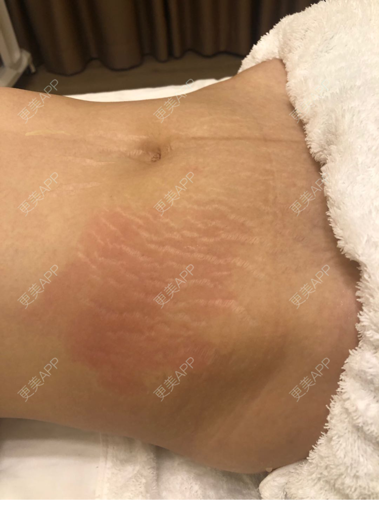 更美用户vje0lldrhh的妊娠纹日记