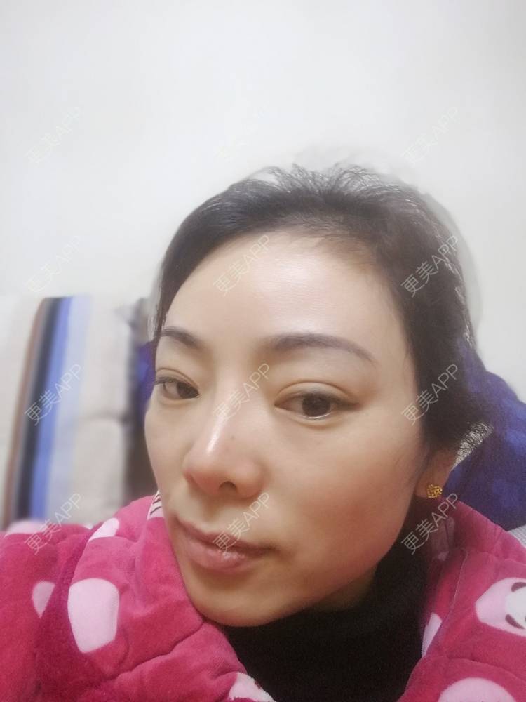 更美 - 代带的自体脂肪丰太阳穴经验 | 自体脂肪丰太阳穴 | 重庆