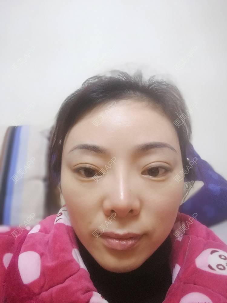 更美 - 代带的自体脂肪丰太阳穴经验 | 自体脂肪丰太阳穴 | 重庆