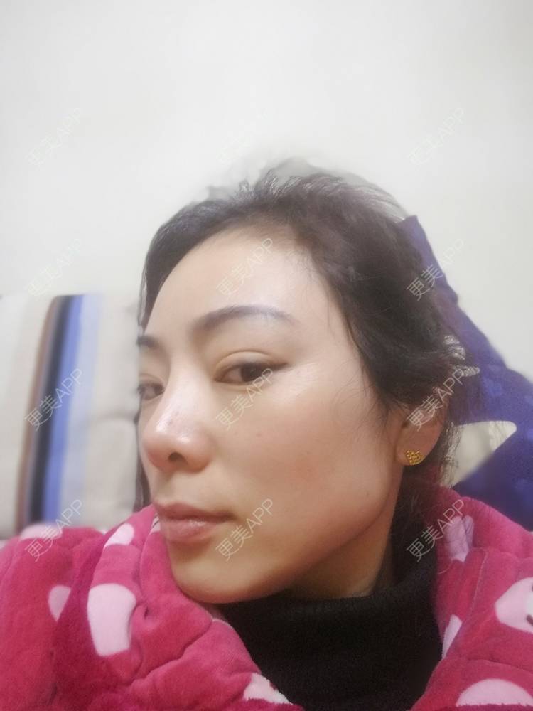 更美 - 代带的自体脂肪丰太阳穴经验 | 自体脂肪丰太阳穴 | 重庆