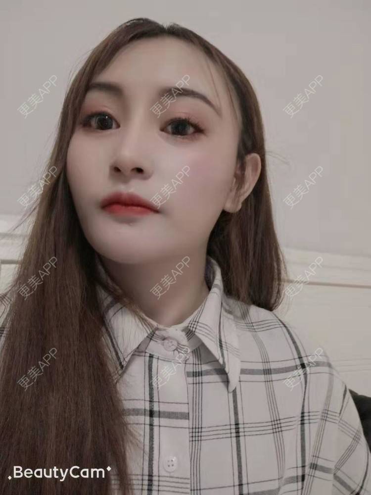 更美 - 更美用户U6Pt7ApV7A的吸脂瘦脸经验 | 吸脂瘦脸 | 重庆