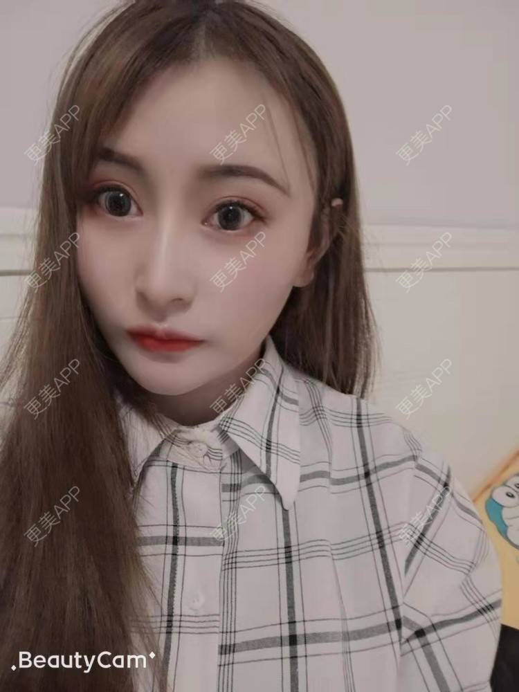 更美 - 更美用户U6Pt7ApV7A的吸脂瘦脸经验 | 吸脂瘦脸 | 重庆
