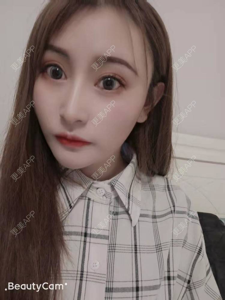 更美 - 更美用户U6Pt7ApV7A的吸脂瘦脸经验 | 吸脂瘦脸 | 重庆