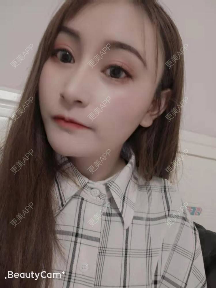 更美 - 更美用户U6Pt7ApV7A的吸脂瘦脸经验 | 吸脂瘦脸 | 重庆