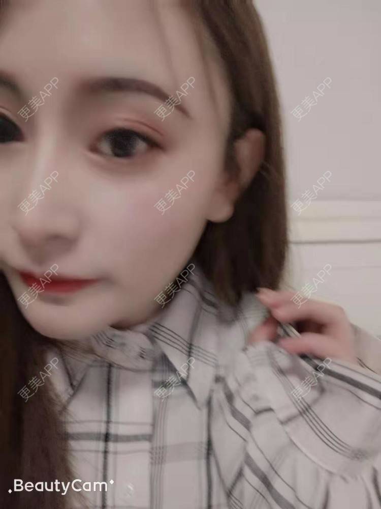 更美 - 更美用户U6Pt7ApV7A的吸脂瘦脸经验 | 吸脂瘦脸 | 重庆