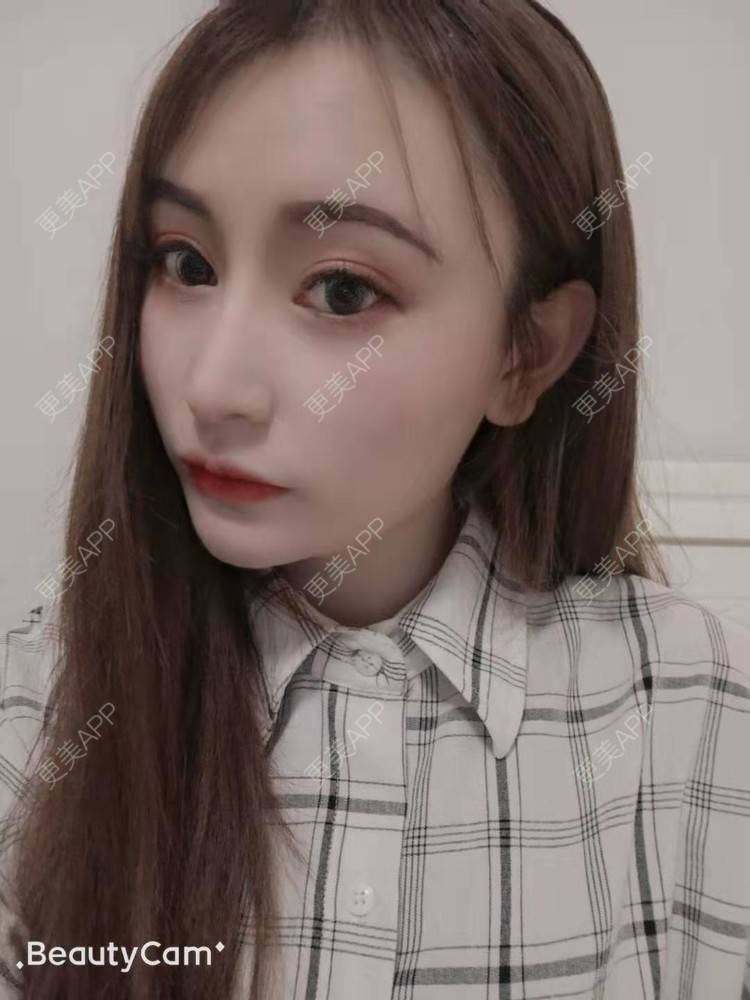 更美 - 更美用户U6Pt7ApV7A的吸脂瘦脸经验 | 吸脂瘦脸 | 重庆