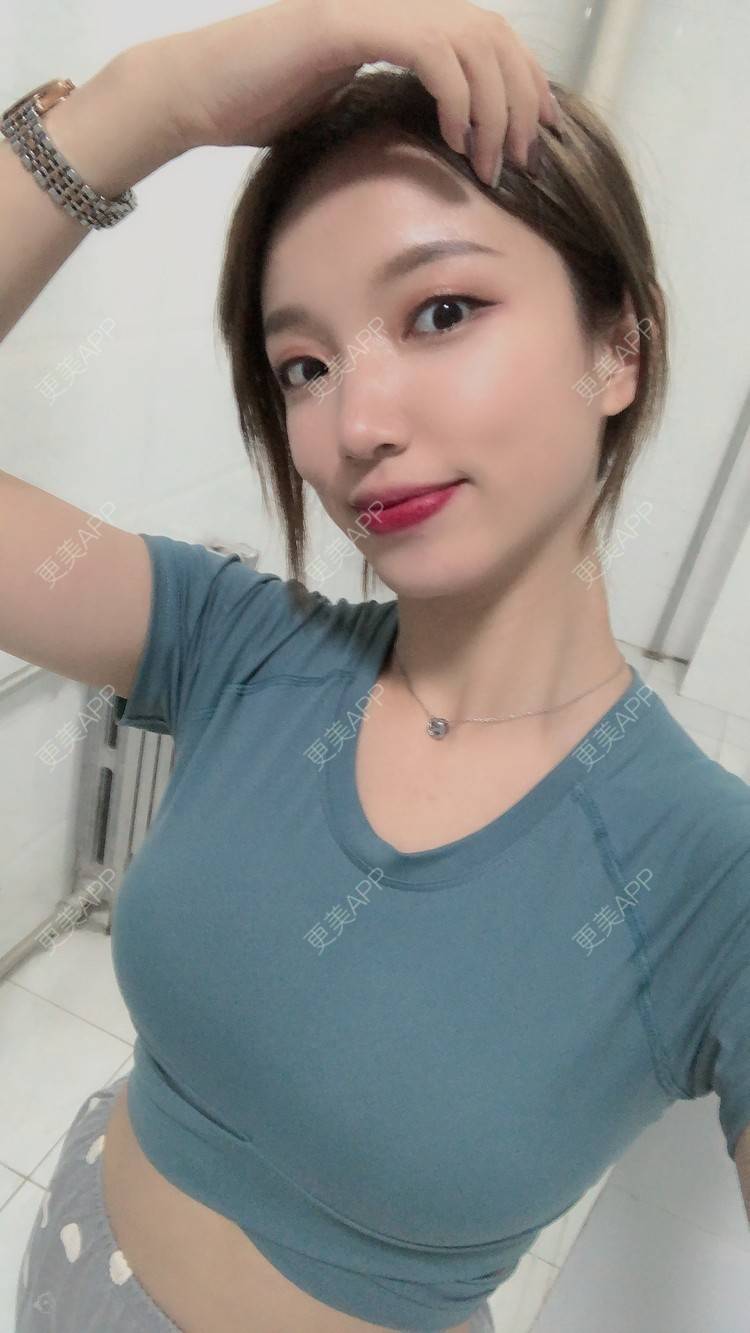 自体脂肪隆胸效果图_情依旧_术后76天__更美