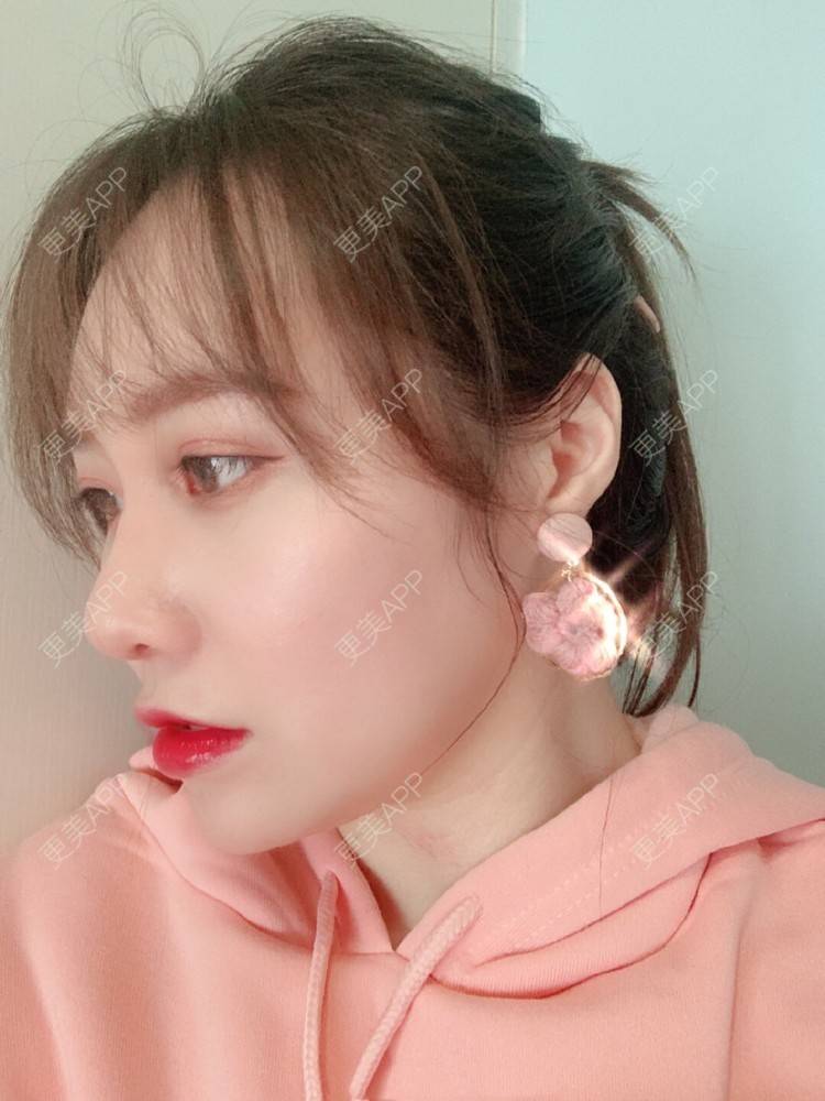 更美用户ffypauka3s的膨体隆鼻日记