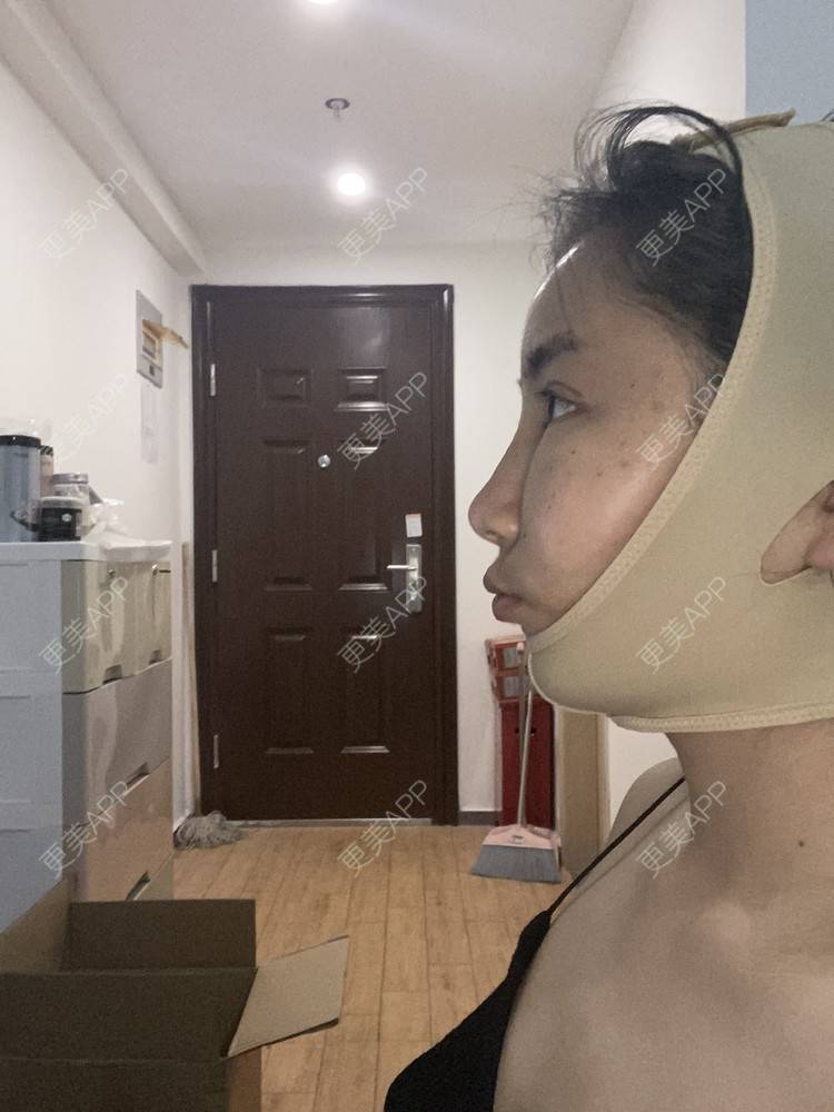 更美 - 哈哈哈镜星的吸脂瘦脸经验 | 吸脂瘦脸 | 西安 | 自体脂肪全面部填充
