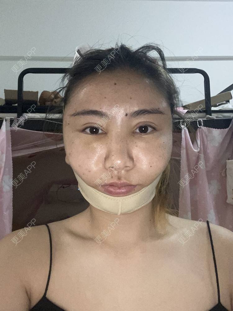 更美 - 哈哈哈镜星的吸脂瘦脸经验 | 吸脂瘦脸 | 西安 | 自体脂肪全面部填充