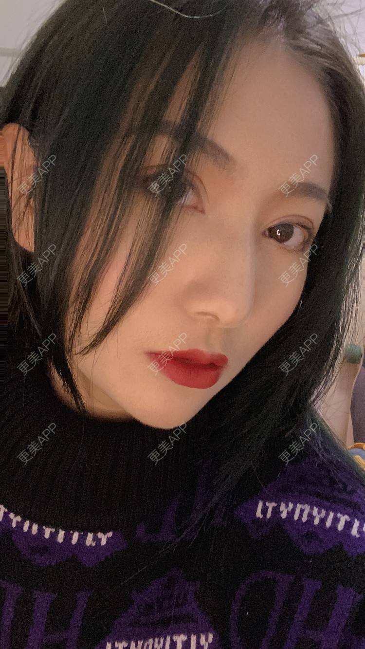 更美 - 哈哈哈镜星的吸脂瘦脸经验 | 吸脂瘦脸 | 西安 | 自体脂肪全面部填充