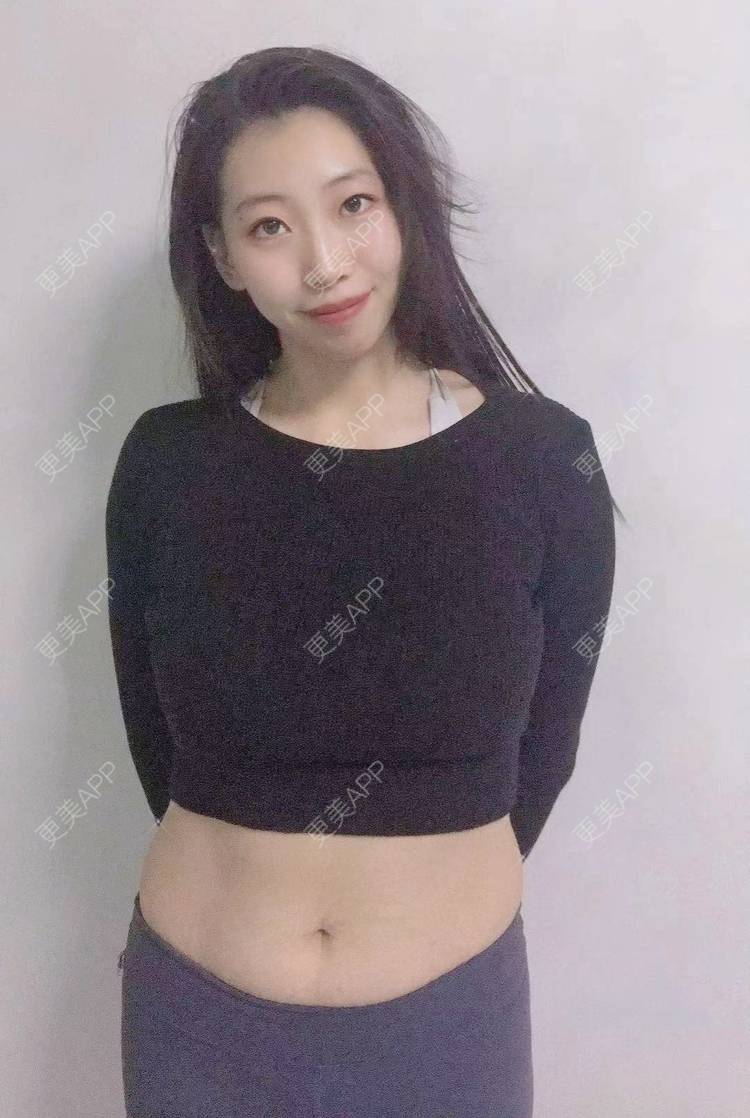 更美 - 更美用户s8sNrAFrkr的激光淡化妊娠纹经验 | 成都 | 激光淡化妊娠纹