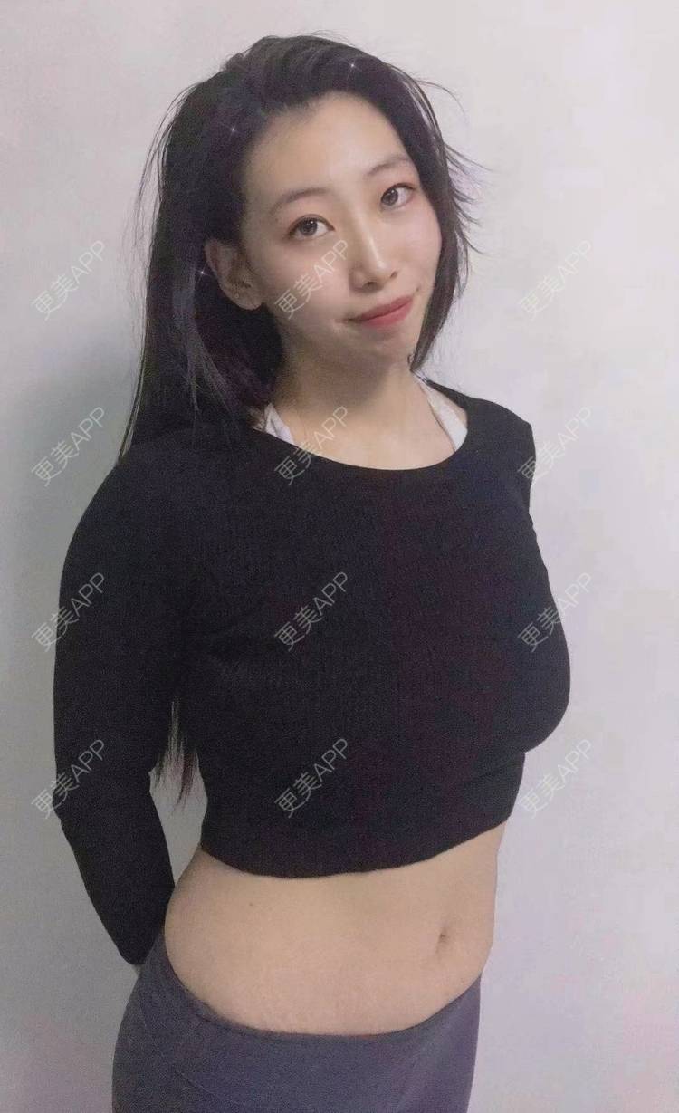 更美 - 更美用户s8sNrAFrkr的激光淡化妊娠纹经验 | 成都 | 激光淡化妊娠纹
